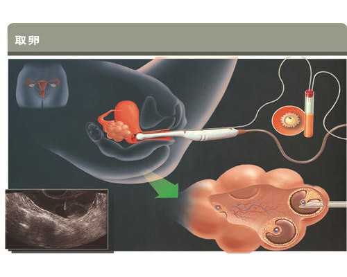 右侧输卵管远端积水与近端积水有何不同？ 哪里有供卵代孕的医院